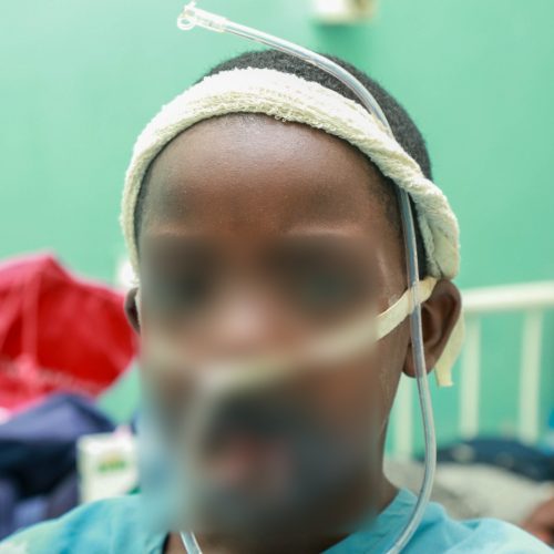 JOOTRH Surgeons Restores 12-Year-Old’s Face After Battery Explosion. JOOTRH Surgeons Restores 12-Year-Old’s Face After Battery Explosion.