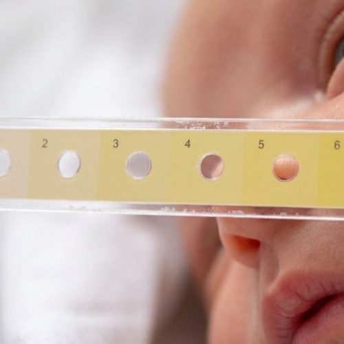 Low-Cost ‘Bili Ruler’ Revolutionizes Neonatal Jaundice Detection at JOOTRH.
